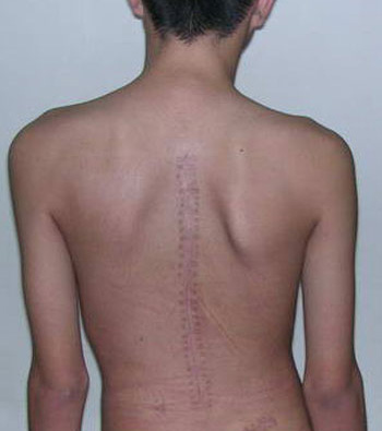 脊柱侧弯患者症状图